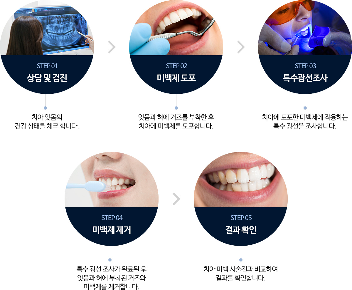 STEP 01 상담 및 검진(치아 잇몸의 건강 상태를 체크합니다.) > STEP 02 미백제 도포(잇몸과 혀에 거즈를 부착한 후 치아에 미백제를 도포합니다.) > STEP 03 특수광선조사(치아에 도포한 미백제에 작용하는 특수 광선을 조사합니다.) > STEP 04 미백제 제거(특수 광선 조사가 완료된 후 잇몸과 혀에 부착된 거즈와 미백제를 제거합니다.) > STEP 05 결과 확인(치아 미백 시술 전과 비교하여 결과를 확인합니다.)