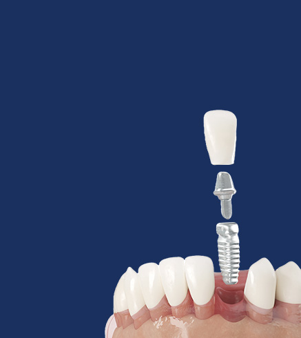 임플란트
